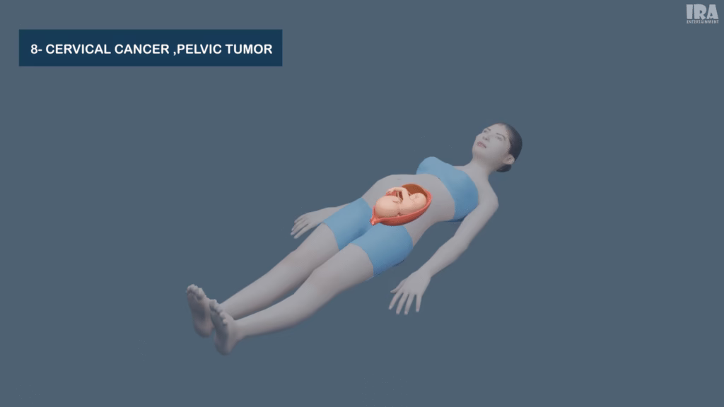 3D medical illustration showing cervical cancer and pelvic tumor in the female reproductive system