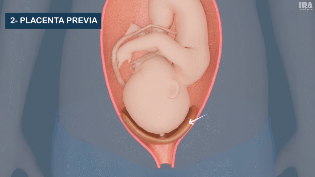3D medical illustration of placenta previa blocking the cervical opening during pregnancy