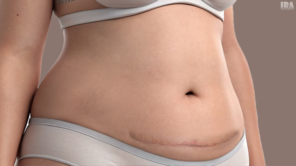 Close-up 3D medical illustration of healed cesarean section scar on lower abdomen