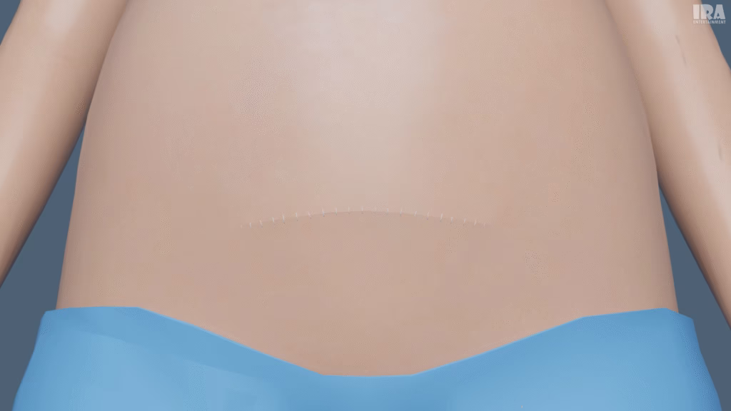 3D medical illustration showing surgical stitching of abdominal layers after cesarean section