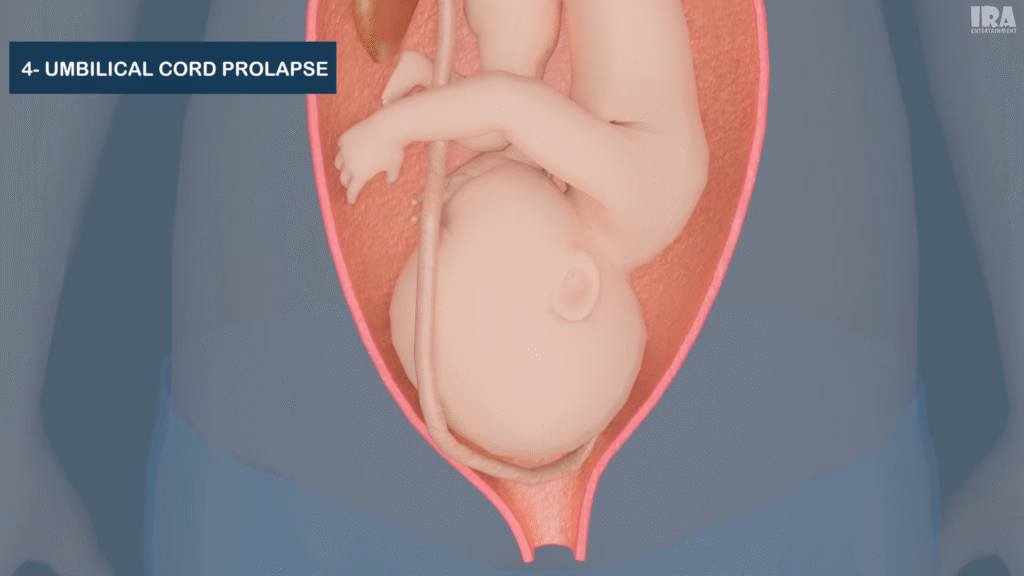 3D medical illustration showing umbilical cord prolapse during childbirth
