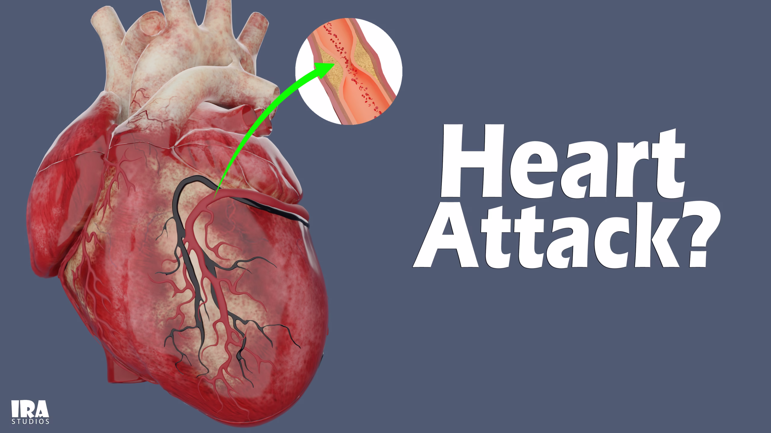 ഹാർട്ട് അറ്റാക്ക്-3D Explanation