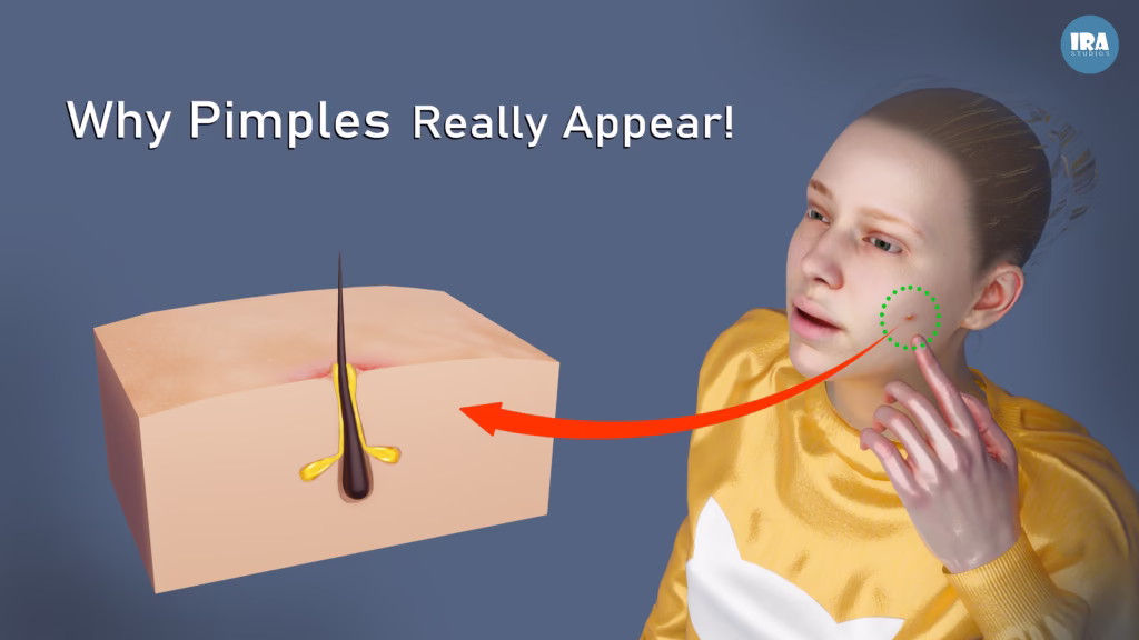 Acne (Pimple) Explained in 3D: Causes, Treatments, and How to Care for Your Skin