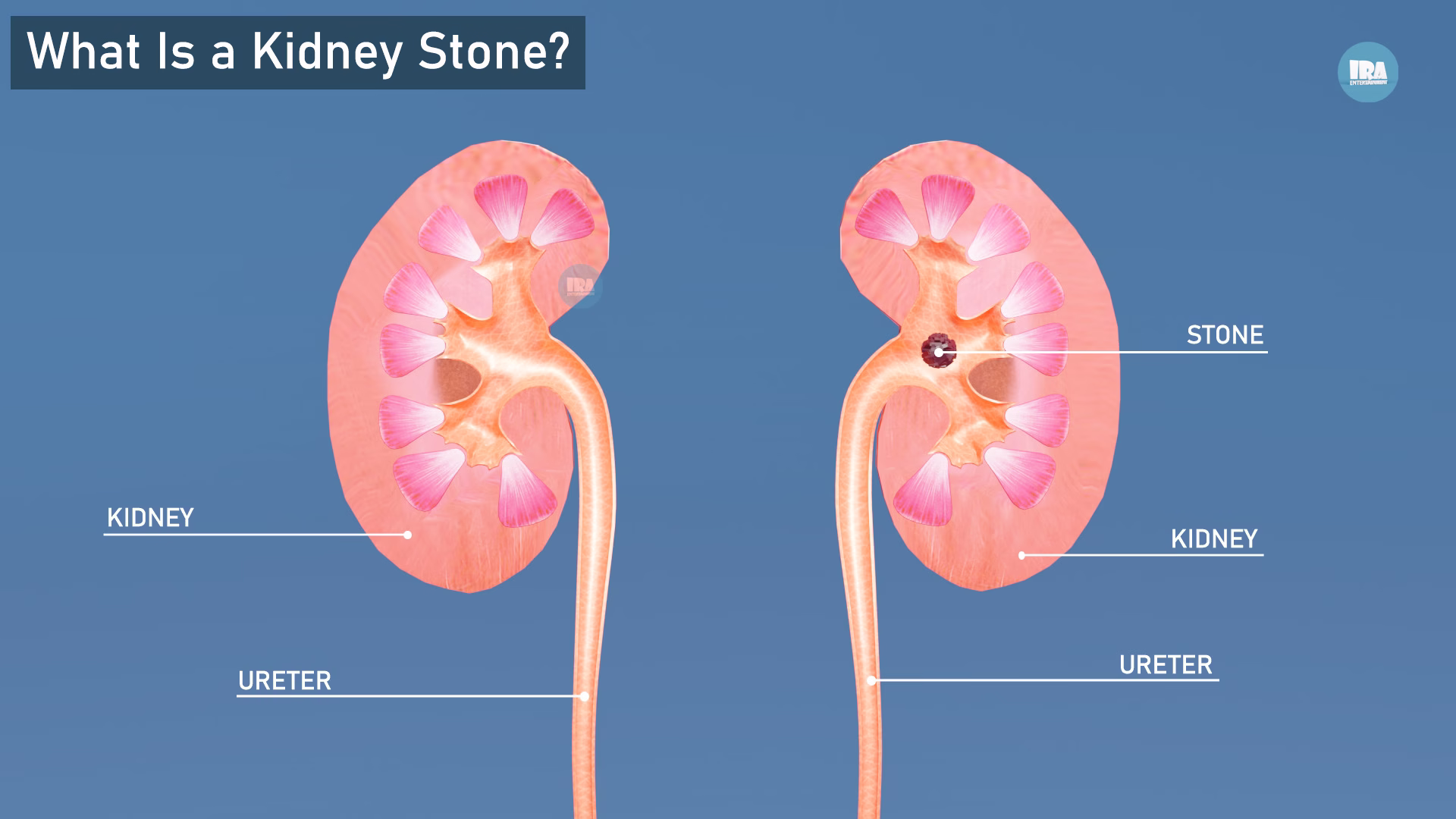 What Is a Kidney Stone? 3D Explanation